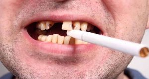 Răng bị ố vàng do chất kích thích