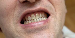Răng bị xỉn màu do tuổi tác