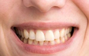 Răng ố vàng, xỉn màu do di truyền