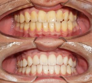 Tẩy trắng răng Đà Nẵng không gây đau, ê buốt