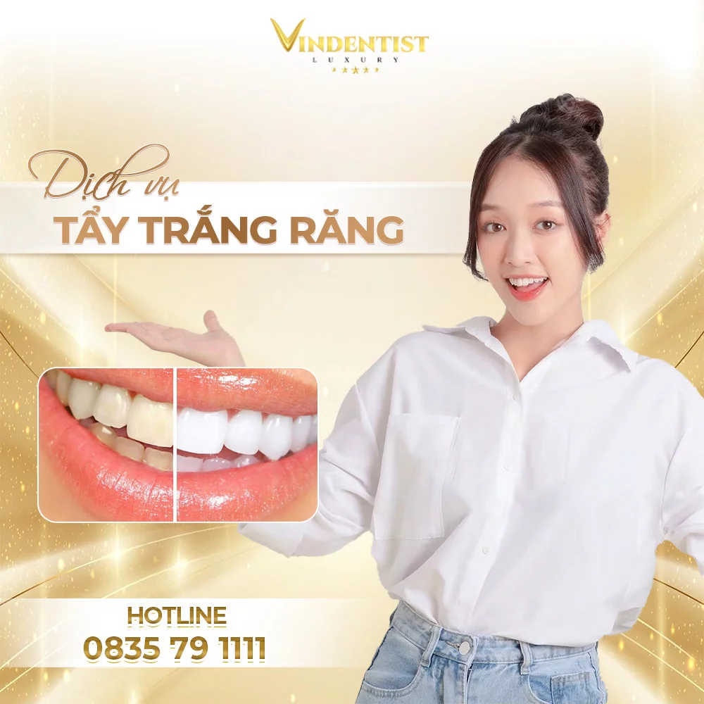 Dịch vụ tẩy trắng răng uy tín tại VIN Dentist Đà Nẵng