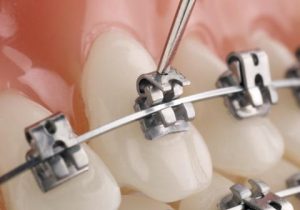 Mắc cài kim loại tự khóa