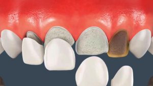 Độ bền răng sứ tương đối cao