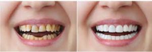 Bọc Răng Sứ Có Tốt Không