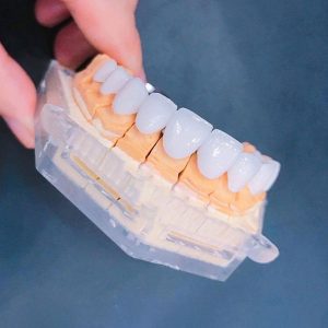 Bọc răng sứ titan có tốt không?