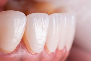 Bọc răng sứ veneer có tốt không?