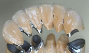 Bọc răng sứ kim loại thường có tốt không?
