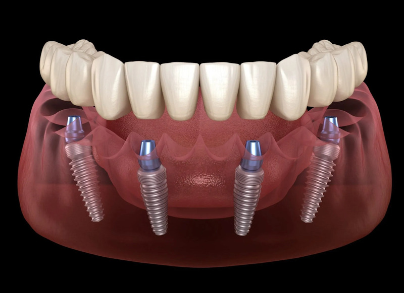 Kỹ thuật trồng răng implant all on4