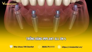 Trồng răng implant all on 4