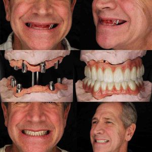 Ưu điểm khi trồng răng implant all on 6