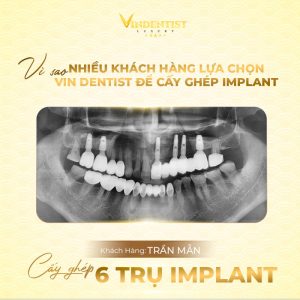 Mức chi phí hợp lý và cực nhiều ưu đãi