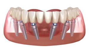 Trồng răng implant all on 6