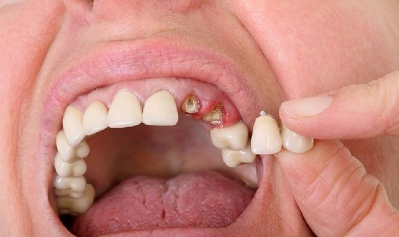 Cần chú ý về tình trạng răng của bệnh nhân