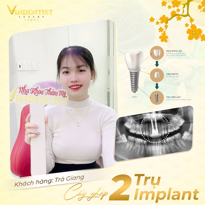 Khách hàng trồng răng implant tại Nha khoa VIN Dentist