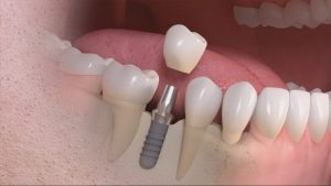 Trồng răng implant là gì?