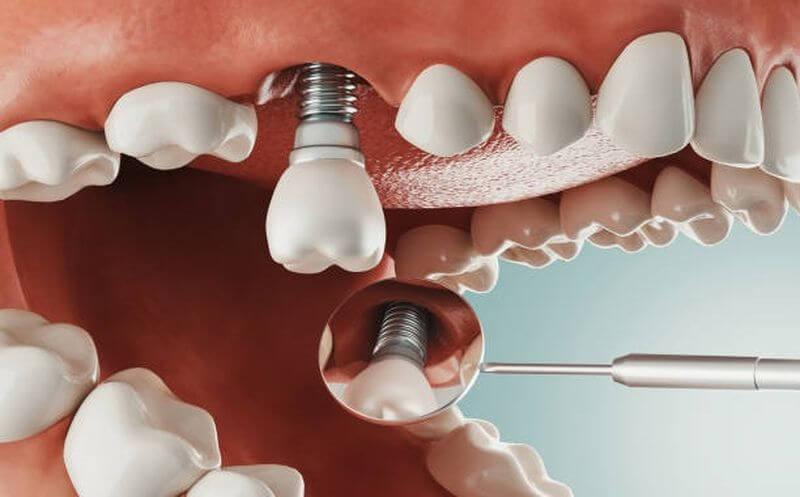 Trồng răng giúp thay thế một hoặc nhiều răng