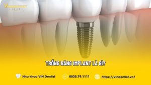 Trồng răng implant là gì?
