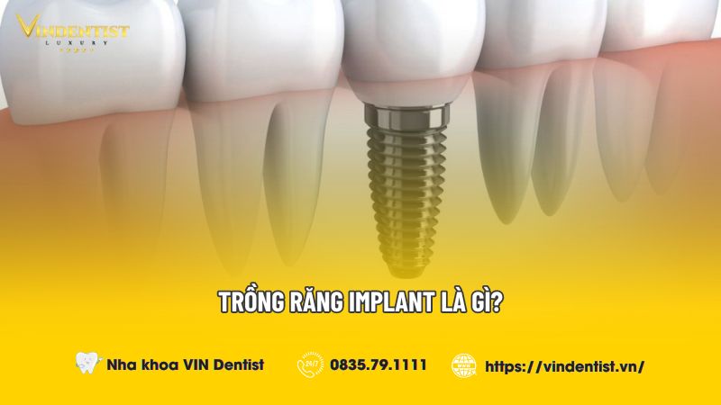 Trồng răng implant là gì?