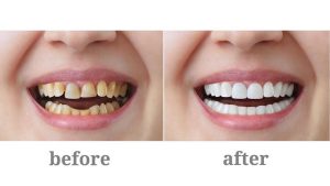 Bọc Răng Sứ Có Bền Không?