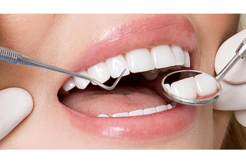 Nên định kỳ kiểm tra răng sứ
