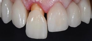 Bác sĩ sẽ gắn răng sứ cố định