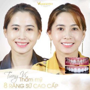 Khách hàng bọc răng sứ tại Nha khoa VIN Dentist