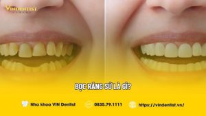 Bọc răng sứ là gì?