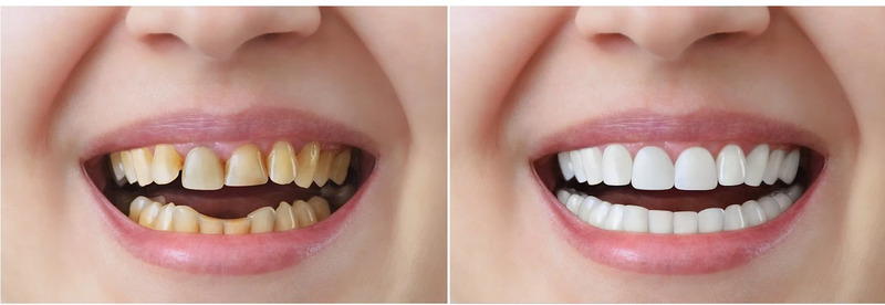 Trường hợp răng ngả màu nên bọc răng sứ