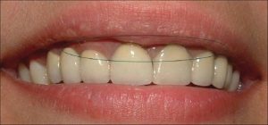 Răng sứ chất lượng kém bị oxy hóa