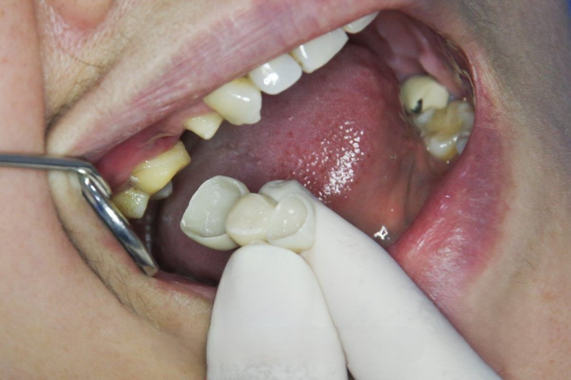 Trường hợp nhạy cảm với răng kim loại, nên thay loại răng sứ khác