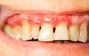 Điều trị khẩn cấp các tình trạng răng miệng