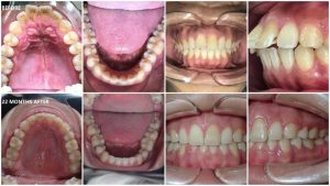 Kết quả niềng răng trong suốt tại Nha khoa VIN Dentist