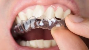 Tiến hành niềng răng trong suốt Leetray