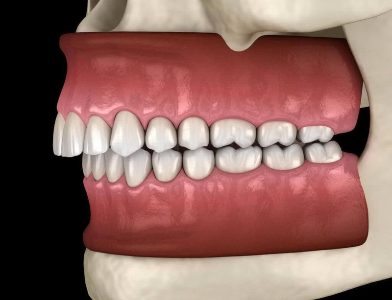 Sai khớp cắn do cấu trúc hàm không nên bọc răng sứ