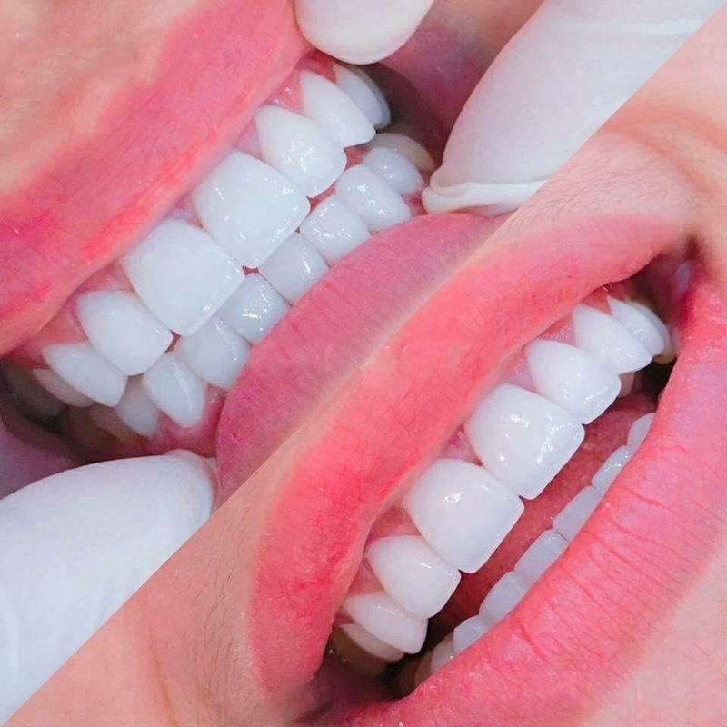 Bọc răng sứ cải thiện thẩm mỹ