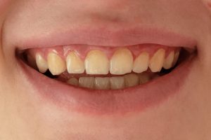 Nên bọc sứ cho răng ố vàng nghiêm trọng