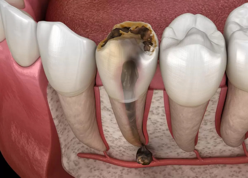 Bọc sứ cho răng bị hư tủy