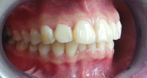 Nên bọc sứ cho răng bị hô nhẹ