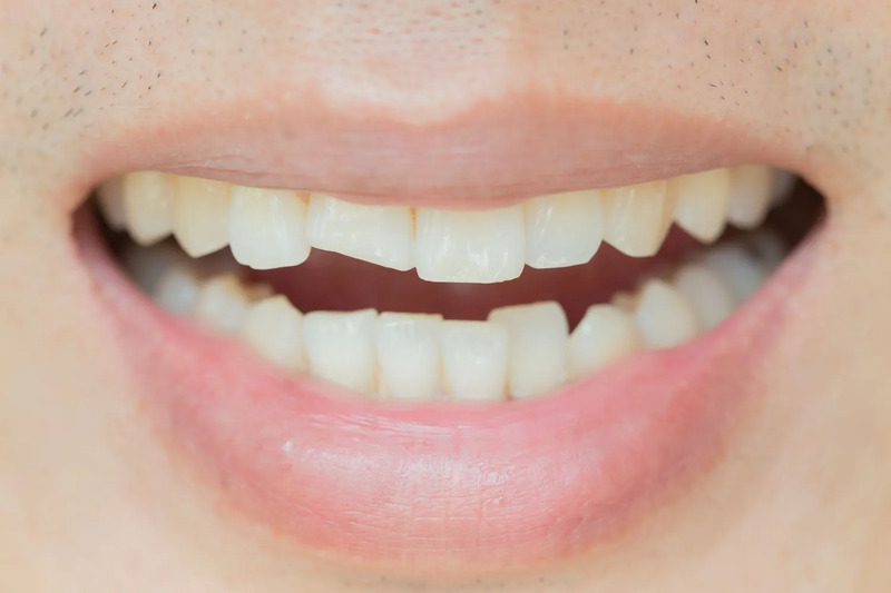 Răng bị mẻ hoặc mất một phần