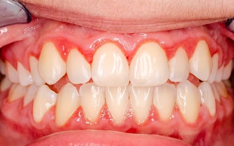 Người bị mắc bệnh lý về nướu cũng không nên bọc răng sứ