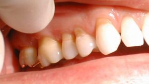 Răng bị mòn nặng không nên bọc răng sứ
