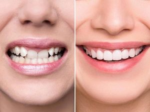 Chi phí bọc răng sứ cao