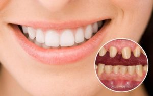 Gây xâm lấn, ảnh hưởng đến răng thật