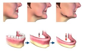 Khắc phục hiện tượng tiêu xương hàm hiệu quả