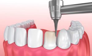 Quá trình mài răng bọc sứ, khi được thực hiện tốt, đảm bảo sức khỏe của hàm răng.