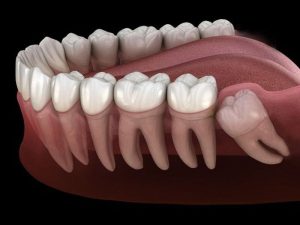 Răng khôn mọc lệch cần phải nhổ răng