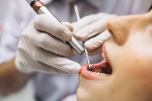 Niềng răng trong suốt có phải nhổ răng không?