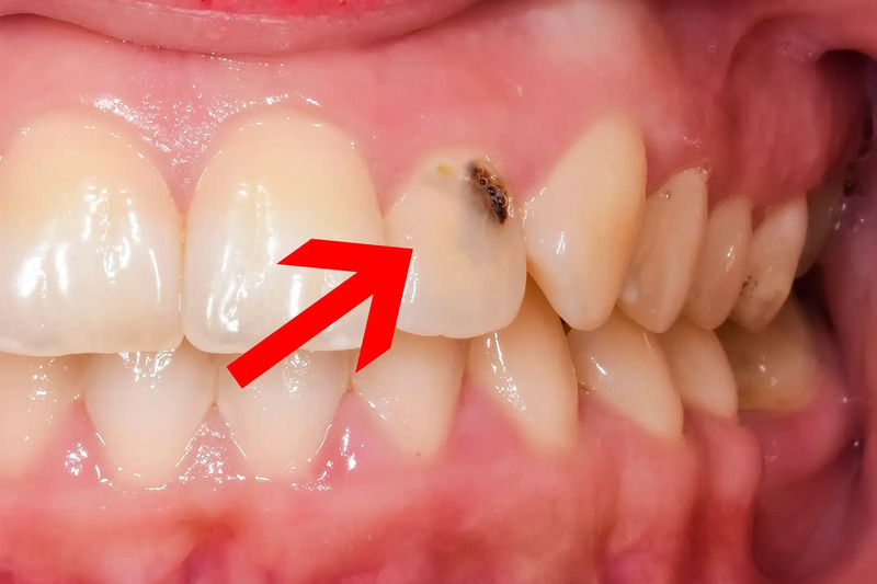 Niềng Răng Trong Suốt Có Phải Nhổ Răng Không? VIN Dentist 13 Một số răng bị các bệnh lý về răng miệng