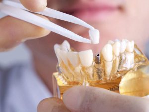 Thời gian phục hình sứ trên trụ implant