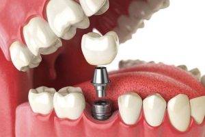 Thời gian phẫu thuật đặt trụ implant